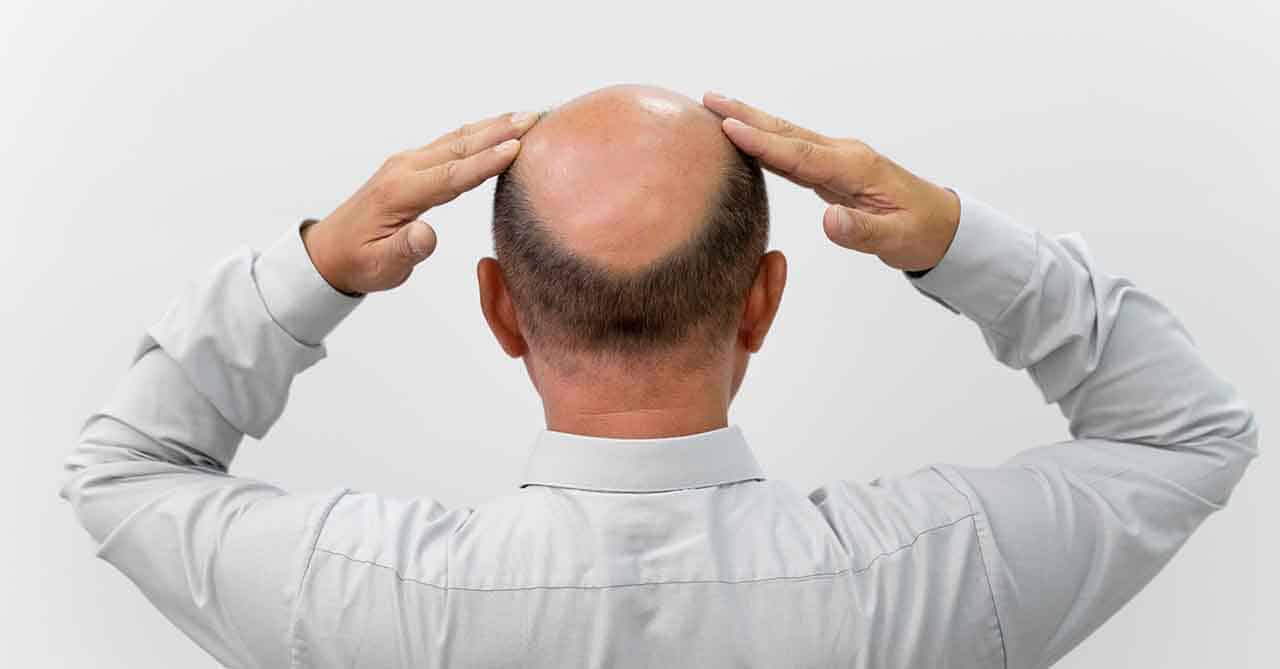 Androgenetic Alopecia .Causes of Hair Loss hair fall sol cause of hair fall