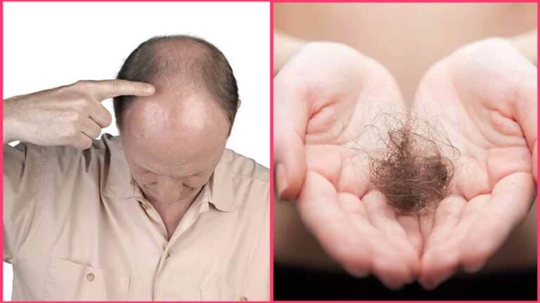 hair thinning