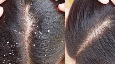 Remedies for Dandruff